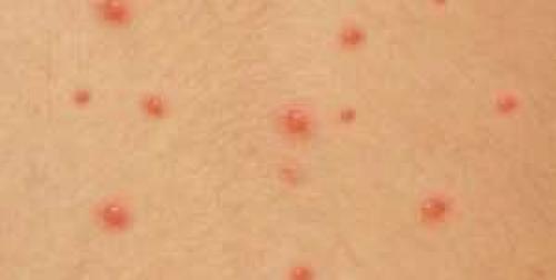 Влияние сахарного диабета на заболевания кожи: причины и профилактика 04