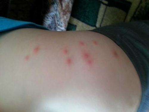 Влияние сахарного диабета на заболевания кожи: причины и профилактика 09