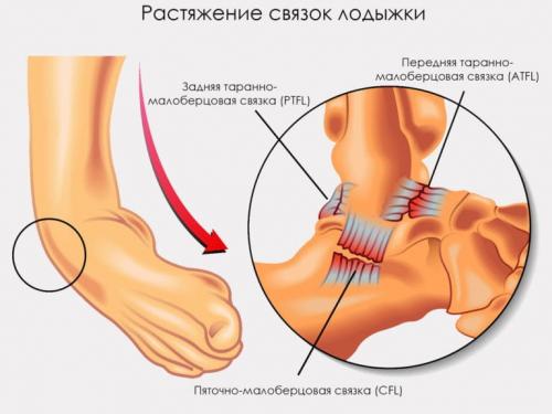 Как быстро происходит восстановление после разрыва связок дистального межберцового соединения. Срок восстановления разрыва и растяжения связок голеностопного сустава