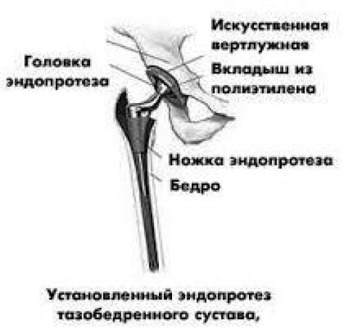 От первых попыток до современных технологий: история эндопротезирования тазобедренного сустава 03