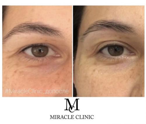 Самые модные процедуры для бровей в 2025 году. ТРЕНД 2025: Лифтинг бровей. Комментарий косметолога на тему самых популярных методик.