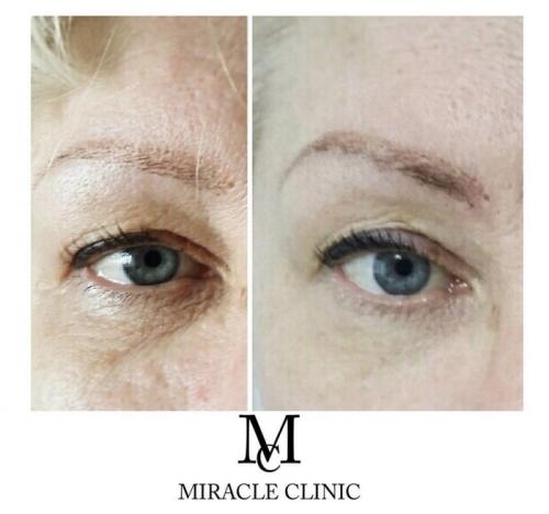 Самые модные процедуры для бровей в 2025 году. ТРЕНД 2025: Лифтинг бровей. Комментарий косметолога на тему самых популярных методик.