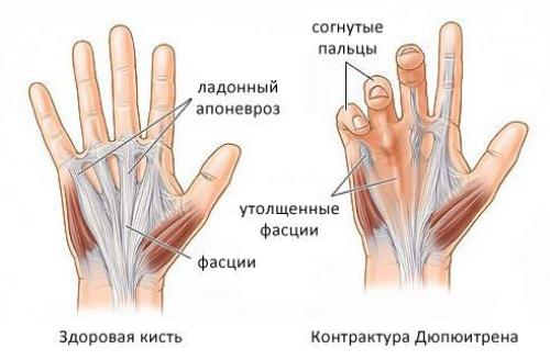 Могут ли шишки на указательном пальце быть связаны с нервными расстройствами. Общие сведения о заболевании