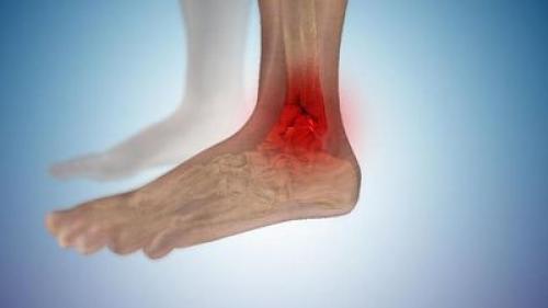 Компрессионный перелом сустава. Что такое компрессионный перелом позвоночника 02