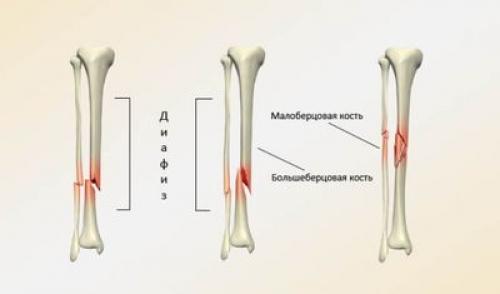 Компрессионный перелом сустава. Что такое компрессионный перелом позвоночника 01