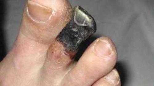 Изменения органов и систем при сахарном диабете. Краткое описание 05