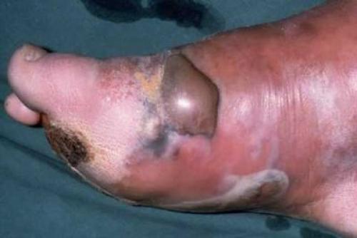 Изменения органов и систем при сахарном диабете. Краткое описание 06