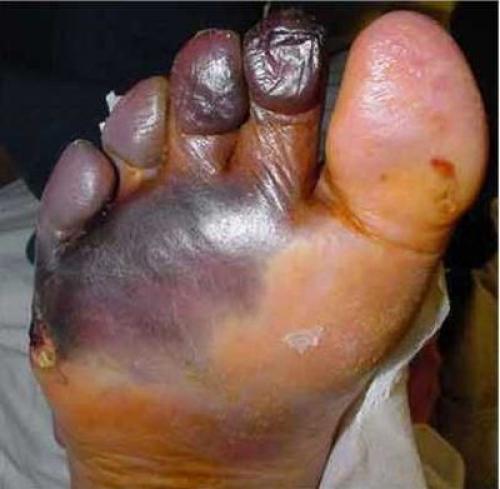 Изменения органов и систем при сахарном диабете. Краткое описание 04