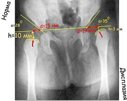 Может ли увеличиться ацетабулярный угол: что нужно знать 01 Может ли увеличиться ацетабулярный угол: что нужно знать 01
