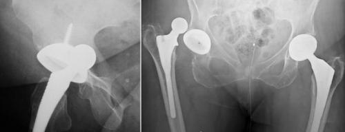 Ревизионное эндопротезирование тазобедренного сустава. Виды имплантов 01
