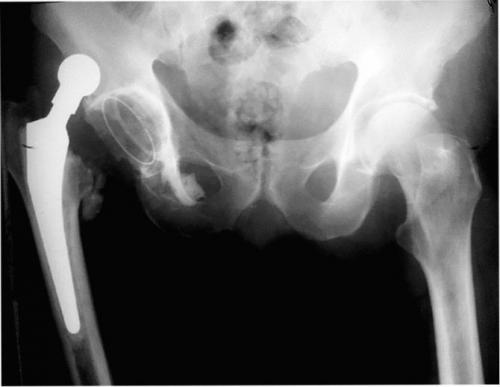 Ревизионное эндопротезирование тазобедренного сустава. Виды имплантов 04
