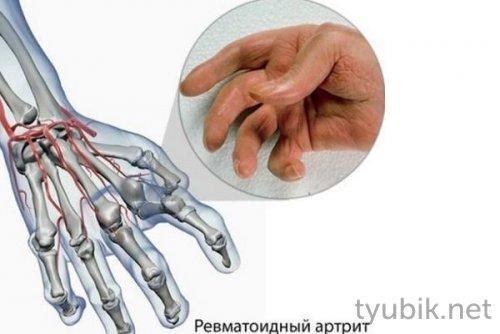 Эффективное лечение суставов: как правильно использовать компресс с димексидом 09 Эффективное лечение суставов: как правильно использовать компресс с димексидом 09