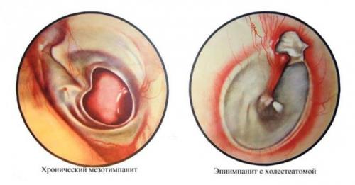 Лечение воспалительных заболеваний среднего уха. Лечение отита 04 Лечение воспалительных заболеваний среднего уха. Лечение отита 04