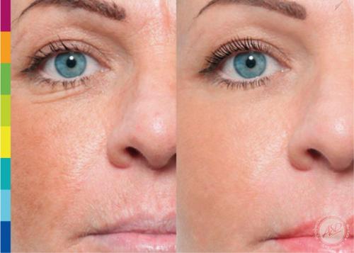 Сухая и обезвоженная кожа. Как отличить сухую кожу от обезвоженной? 08