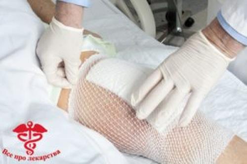 Могут ли возникнуть побочные эффекты при использовании компресса с данными средствами. Как разводить димексид для компресса